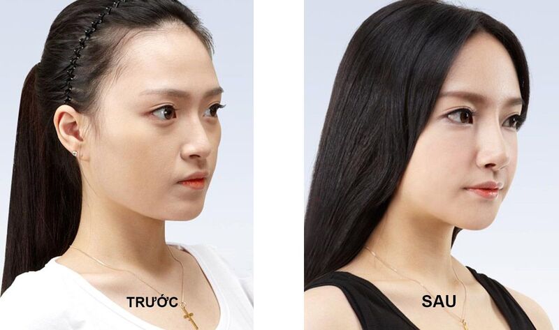 Lấy mỡ bọng mắt ở đâu tại tiền giang