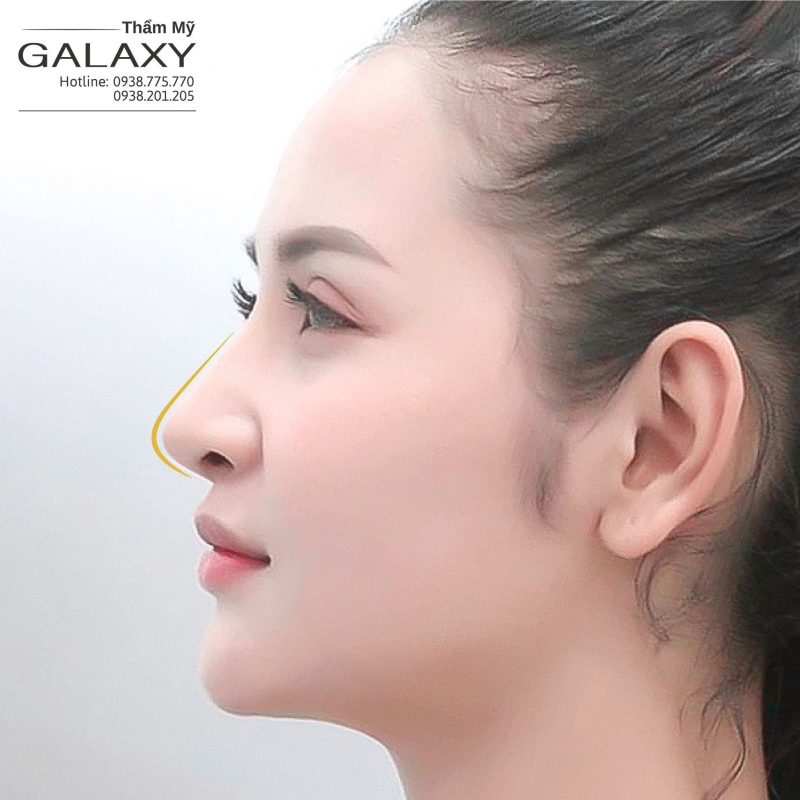 Nâng mũi thẩm mỹ Galaxy Dr Duy