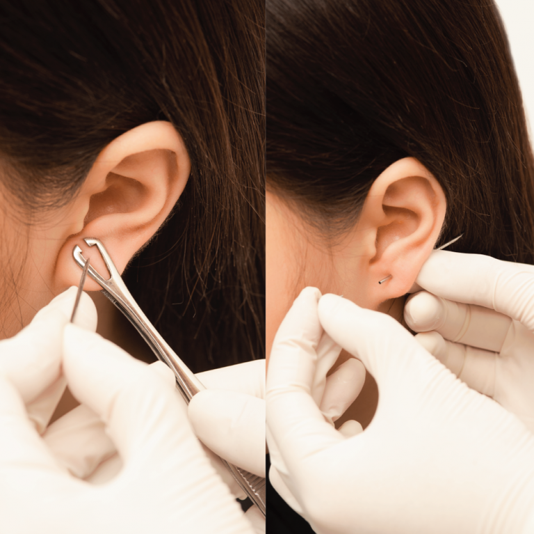 Bump lỗ tai là gì nguyên nhân và cách xử lí