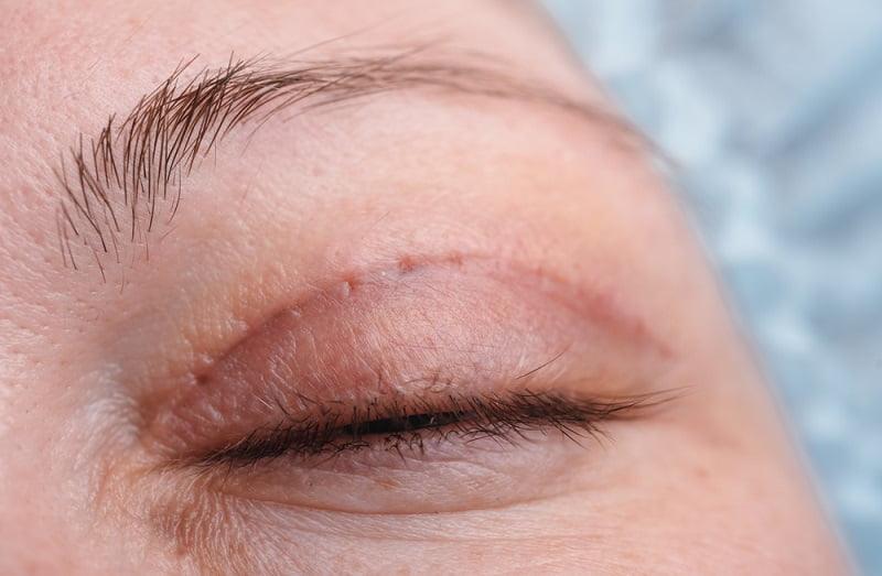 Cắt mí mắt bao lâu thì trang điểm được 