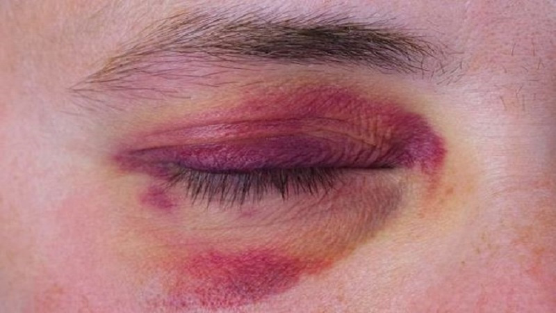 Cắt mí mắt bị bầm tím - Nguyên nhân và cách điều trị ?
