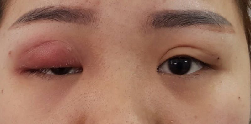 Cắt mí mắt hỏng bao lâu sửa lại được