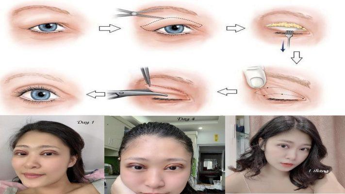 Quy trình cắt mí mắt