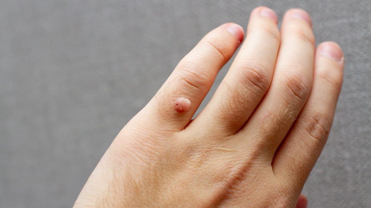 Địa chỉ trị mụn cóc hiệu quả nhất tại quận 6