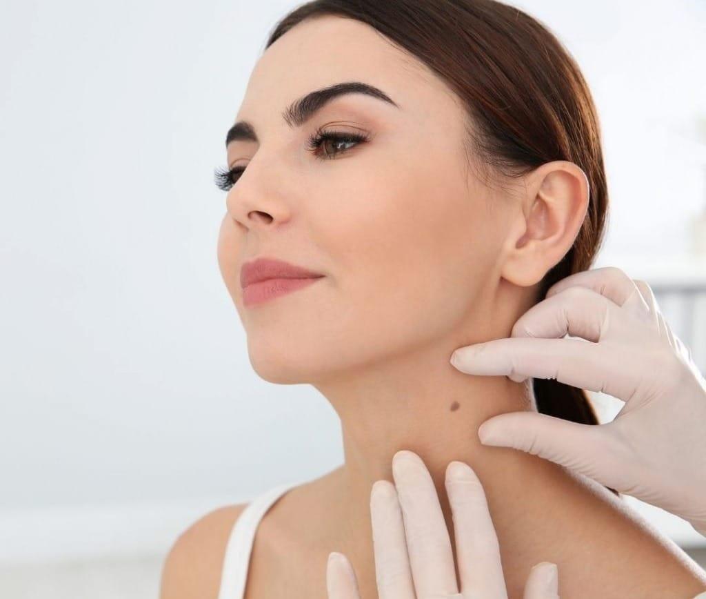 Địa chỉ xóa nốt ruồi hiệu quả nhất tại Long An