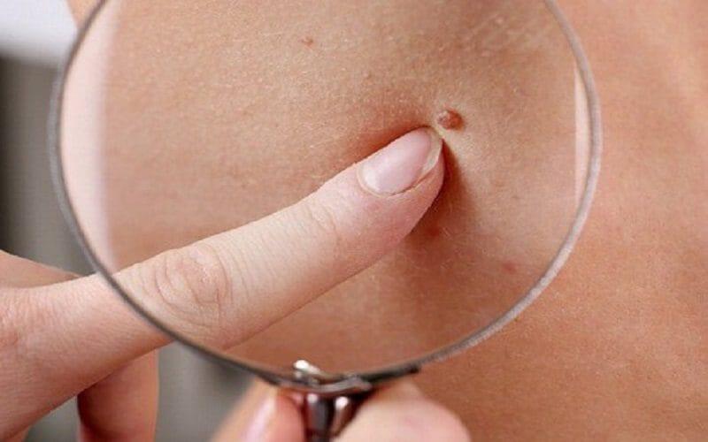 Địa chỉ xoá nốt ruồi hiệu quả nhất tại Tây Ninh