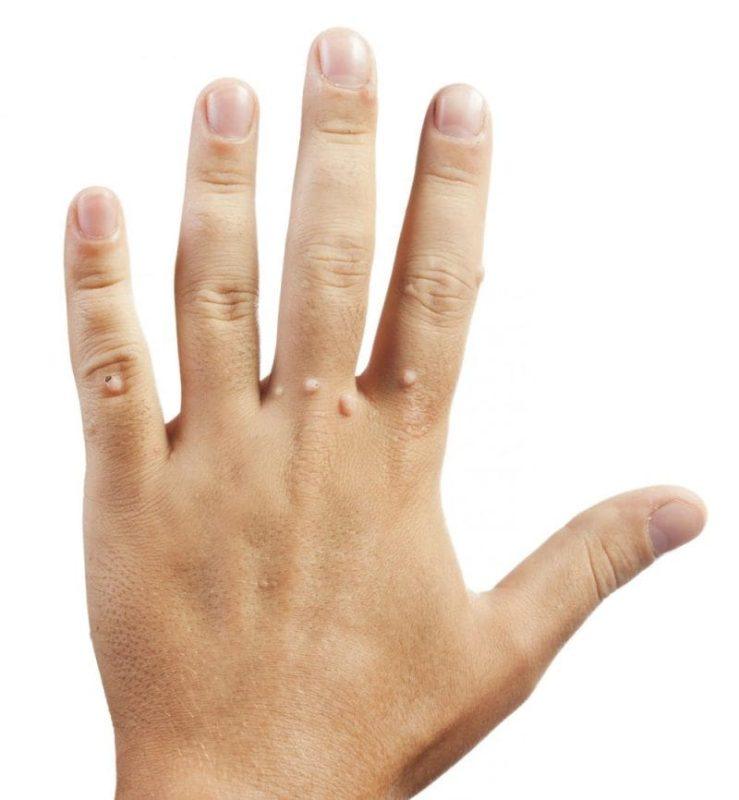 Điều trị mụn cóc quận 6