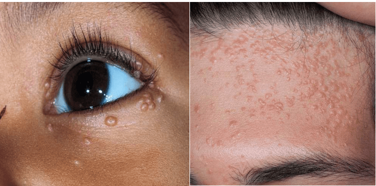 Điều trị mụn tại bình phước