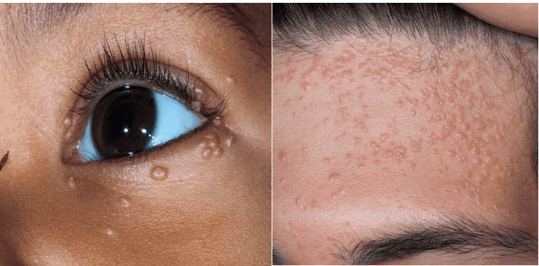 Điều trị mụn thịt tại long an