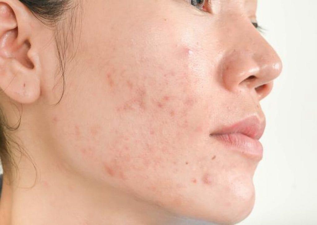 Trị mụn bình dương