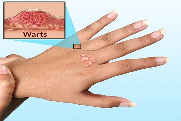 Địa chỉ trị mụn cóc hiệu quả nhất tại Bình Dương