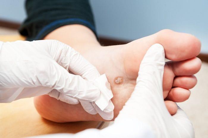 Địa chỉ trị mụn cóc hiệu quả nhất tại Bình Dương