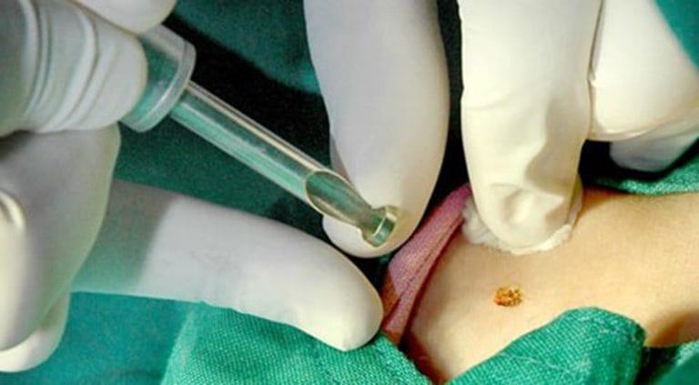 Địa chỉ trị mụn cóc hiệu quả nhất tại Bình Dương