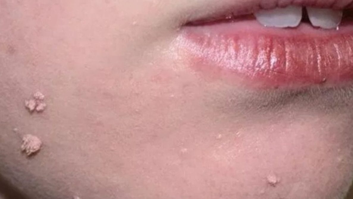 Địa chỉ trị mụn cóc hiệu quả nhất tại Tây Ninh