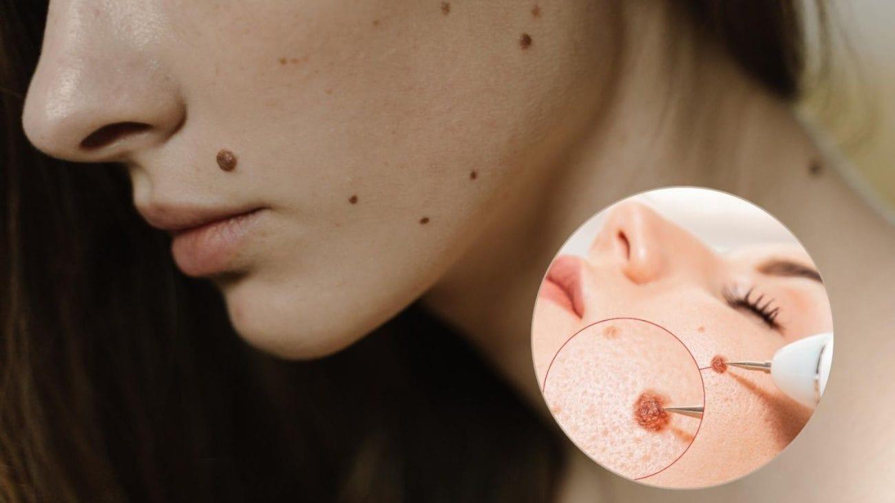 Địa chỉ xoá nốt ruồi hiệu quả nhất tại TPHCM