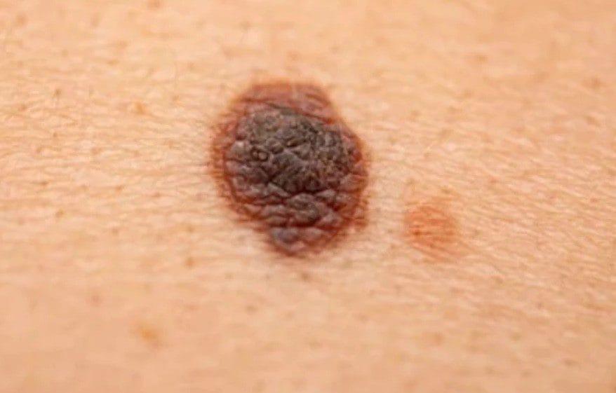 Địa chỉ xoá nốt ruồi hiệu quả nhất tại TPHCM