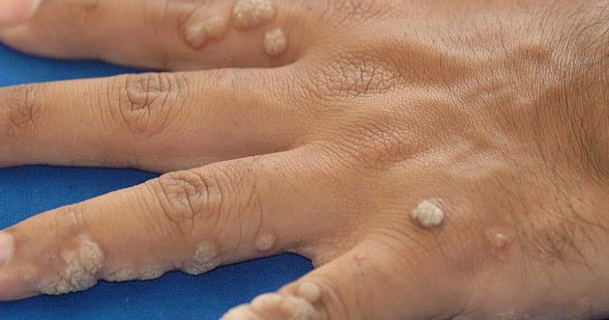 Địa chỉ trị mụn cóc hiệu quả nhất tại Đồng Nai
