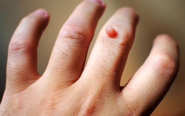 địa chỉ trị mụn cóc hiệu quả nhất tại đồng nai