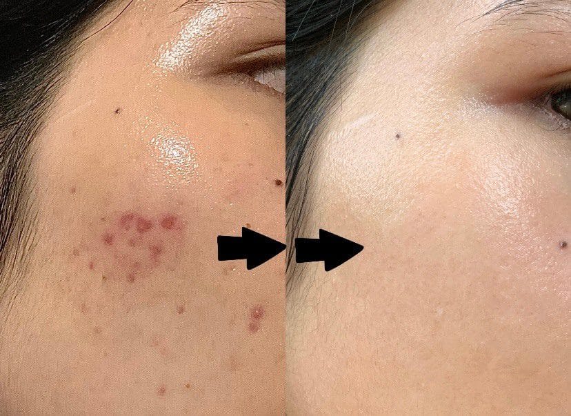Địa chỉ trị mụn, mụn mủ,mụn trứng cá, mụn đầu đen hiệu quả nhất tại Bình Phước