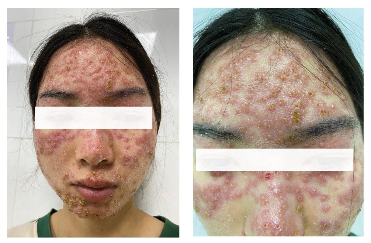 Địa chỉ trị mụn, mụn mủ, mụn trứng cá, mụn đầu đen hiệu quả nhất tại Đồng Nai