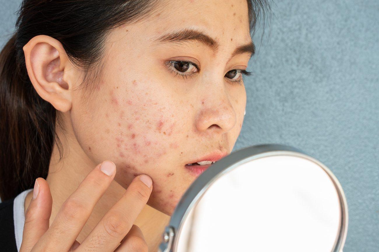 Địa chỉ trị mụn, mụn mủ,mụn trứng cá,mụn đầu đen hiệu quả nhất tại TP. Hồ Chí Minh