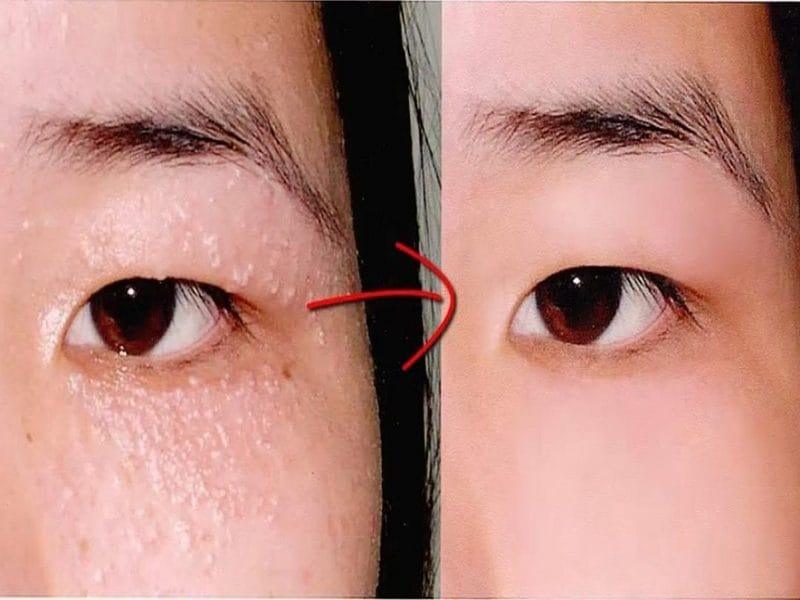 Địa chỉ trị mụn thịt hiệu quả nhất tại Đồng Nai