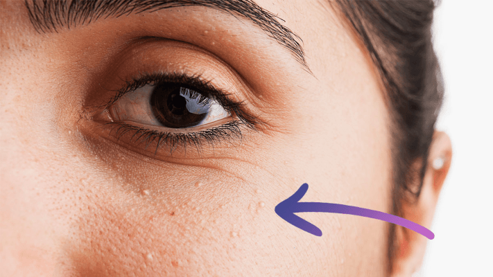 Địa chỉ trị mụn thịt hiệu quả nhất tại quận 6