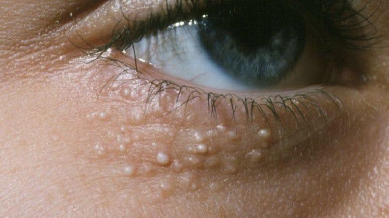 Địa chỉ trị mụn thịt hiệu quả nhất tại Tây Ninh