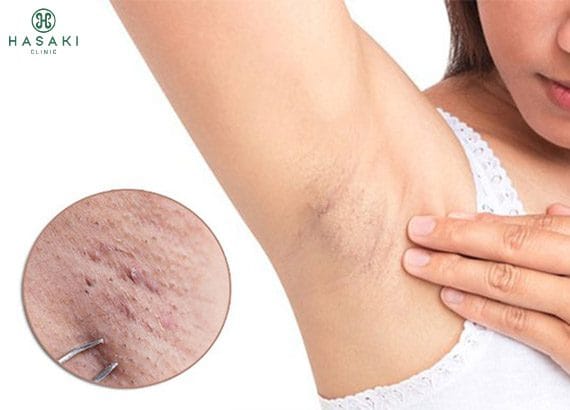 triệt lông tại hcm