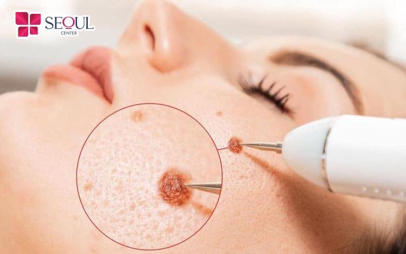 Địa chỉ xoá nốt ruồi tại Quận 6 uy tín, hiệu quả, an toàn (SGR)
