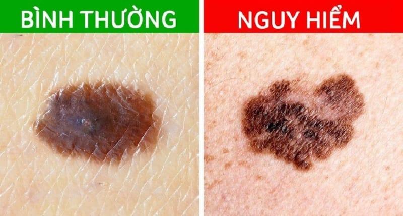 Địa chỉ xóa nốt ruồi hiệu quả nhất tại quận 6
