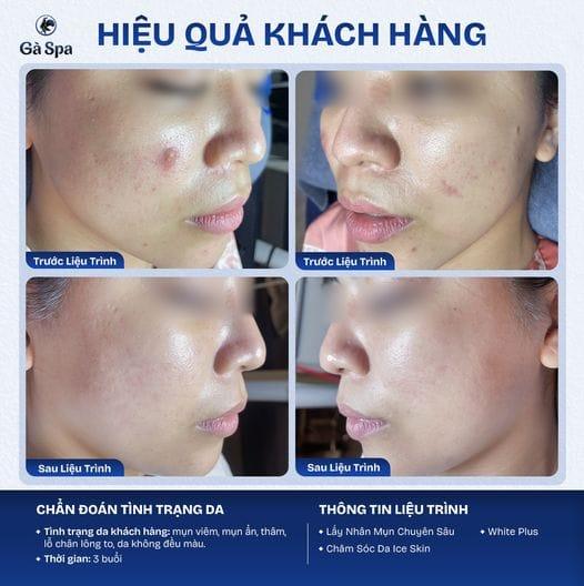 Điều trị mụn tây ninh