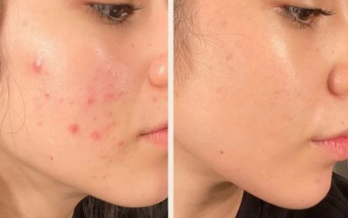 Điều trị mụn đồng nai