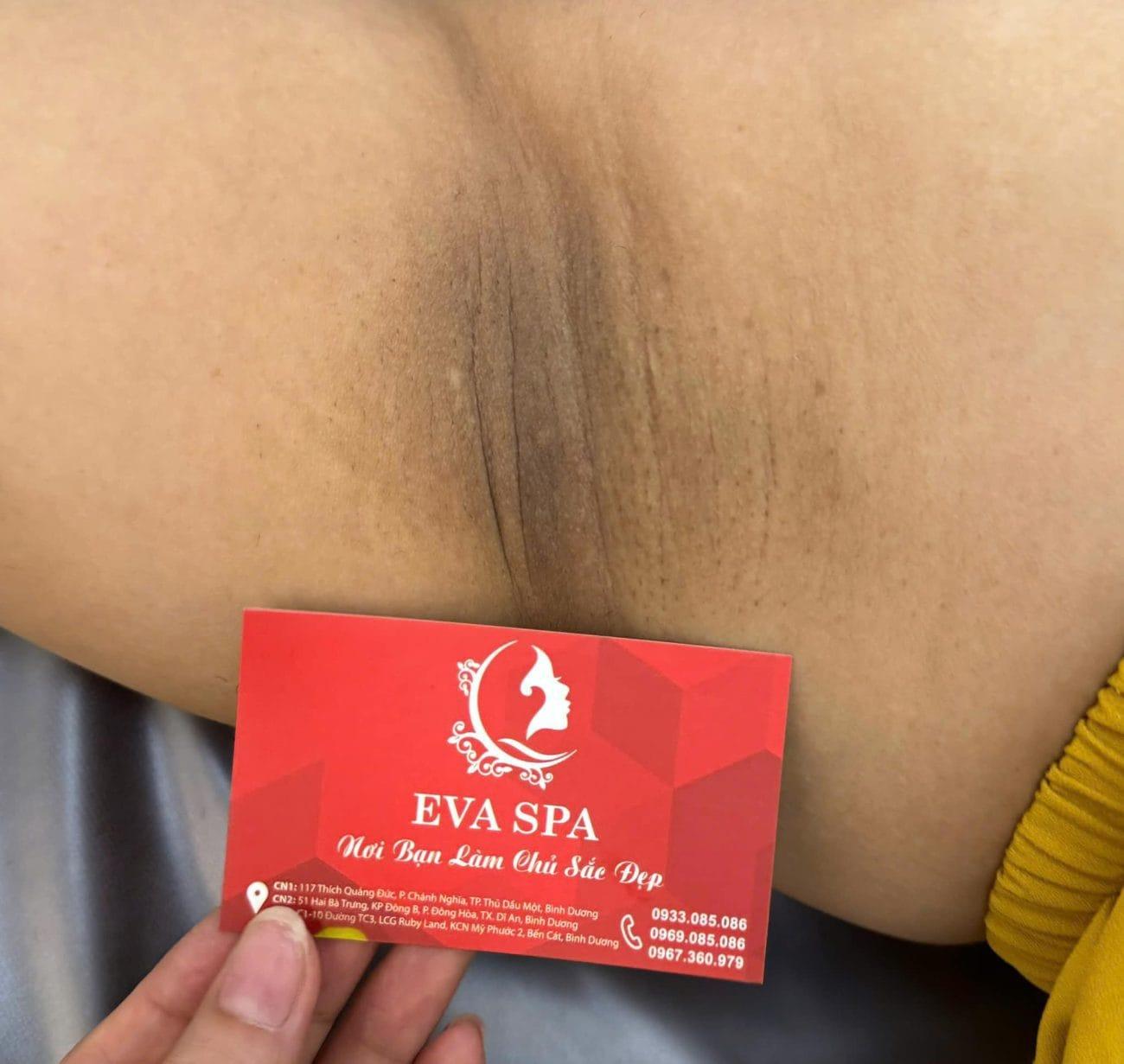 Địa chỉ trị thâm nách, bẹn hiệu quả nhất tại Bình Dương