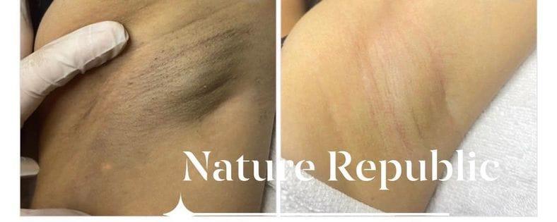 Địa chỉ trị thâm nách, bẹn hiệu quả nhất tại Đồng Nai