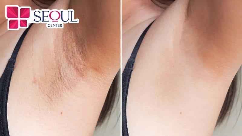 Địa chỉ trị thâm nách, bẹn hiệu quả nhất tại TPHCM