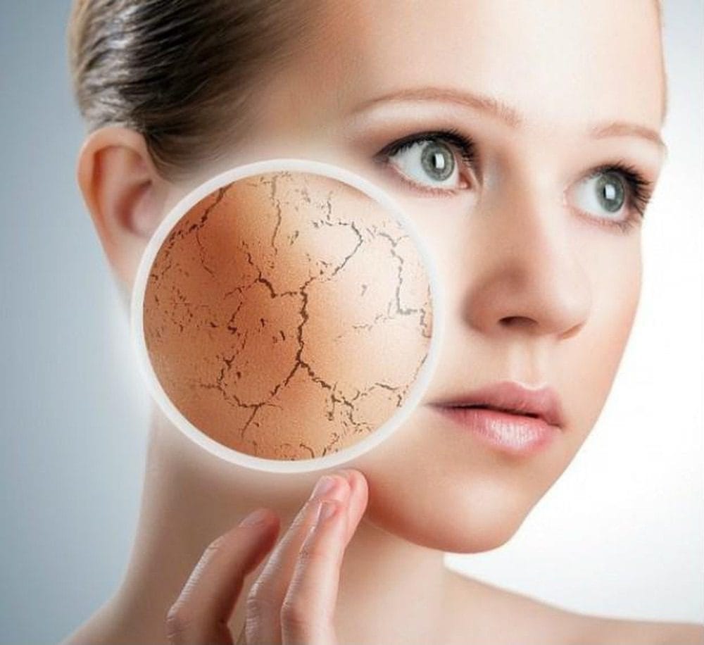 Điều trị mụn cho da khô không gây kích ứng, dễ làm tại nhà