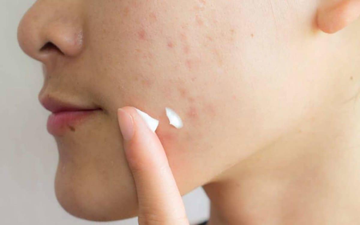 Điều trị mụn không để lại thâm cho làn da khỏe khoắn, tươi tắn