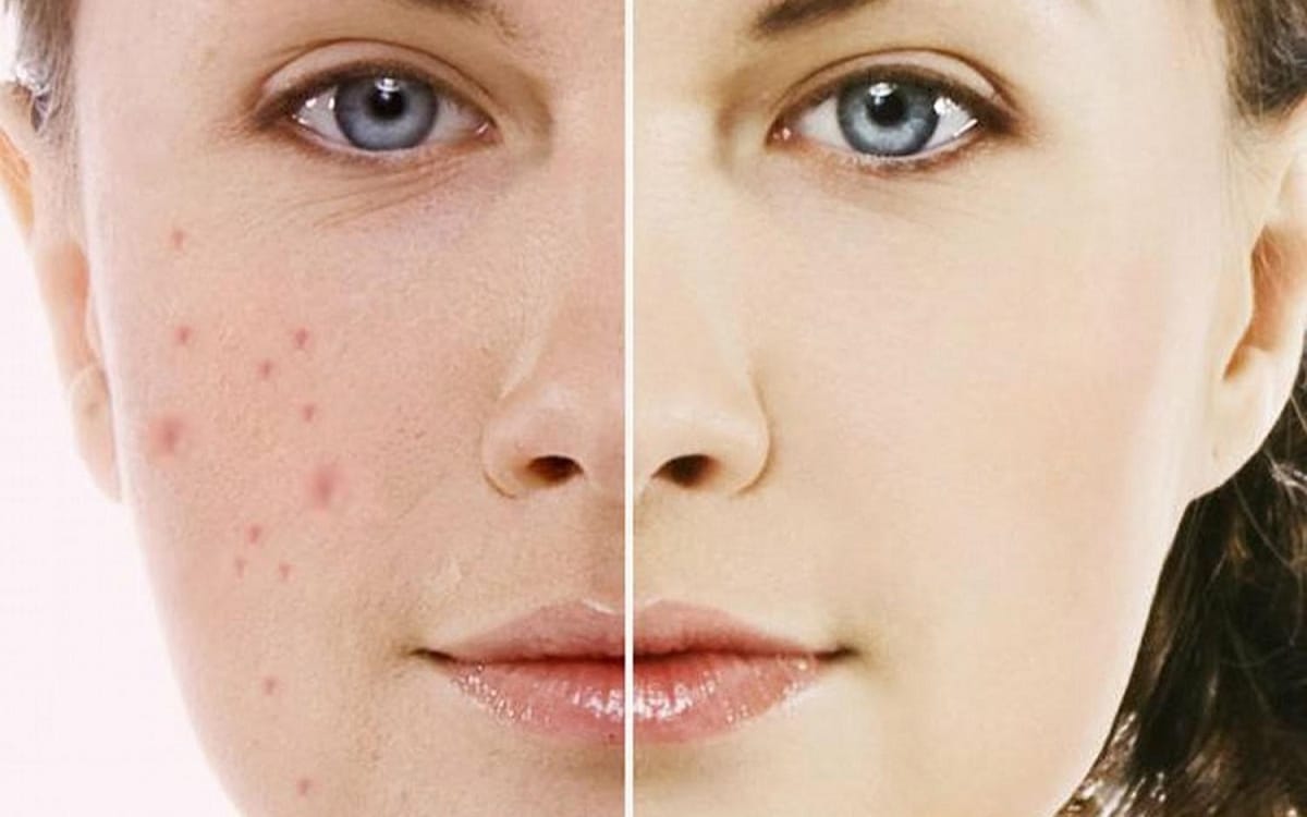Điều trị mụn không để lại thâm cho làn da khỏe khoắn, tươi tắn