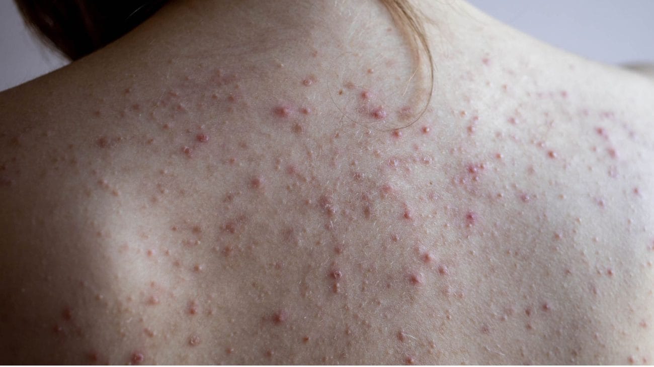 Phương pháp điều trị mụn lưng hiệu quả, xoá sạch vết thâm