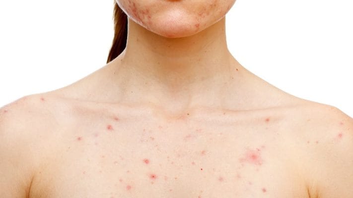 Điều trị mụn ngực nhanh chóng, không để lại viết thâm
