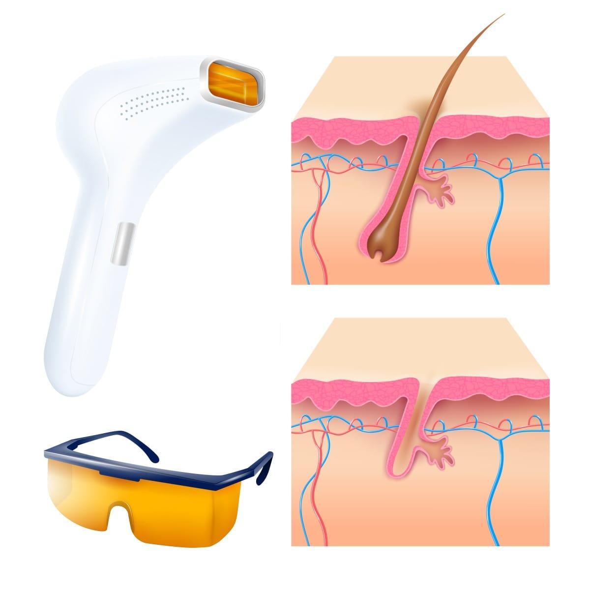 Tác dụng không mong muốn của triệt lông bằng laser