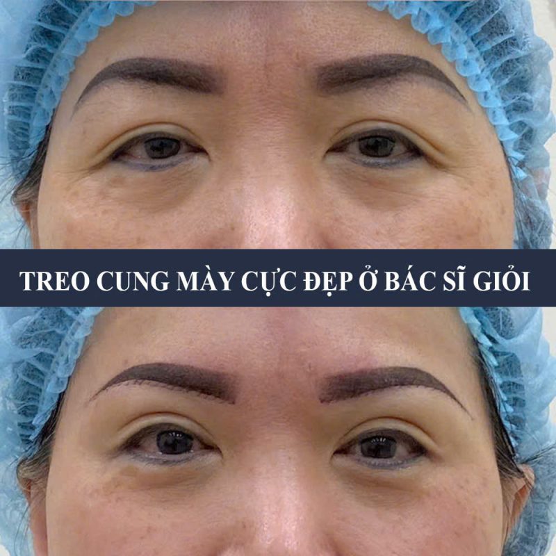 nâng cung chân mày hcm