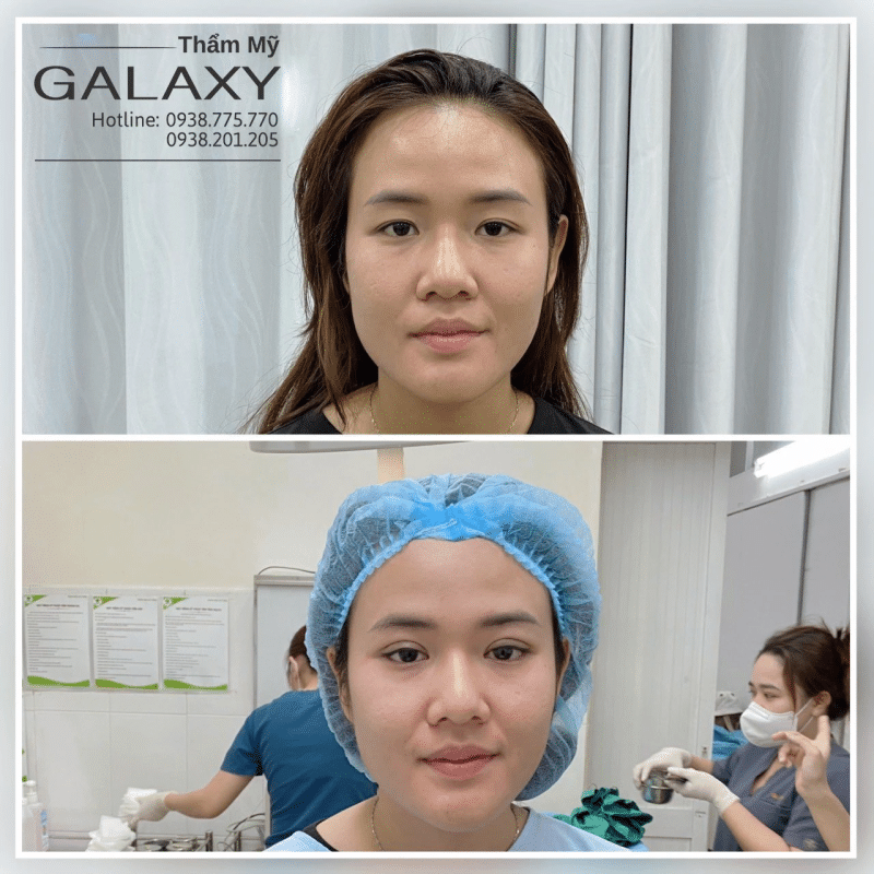 Cắt mí mắt phong thủy hcm