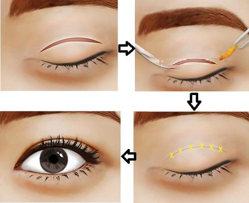 Cắt mí mắt phong thủy tphcm