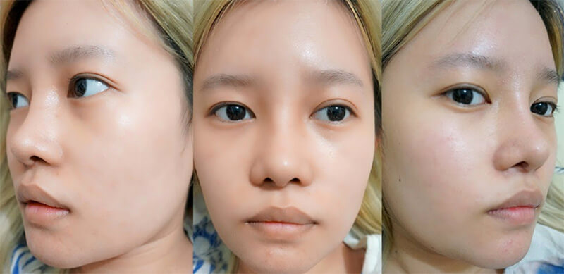 sửa mũi hư hcm