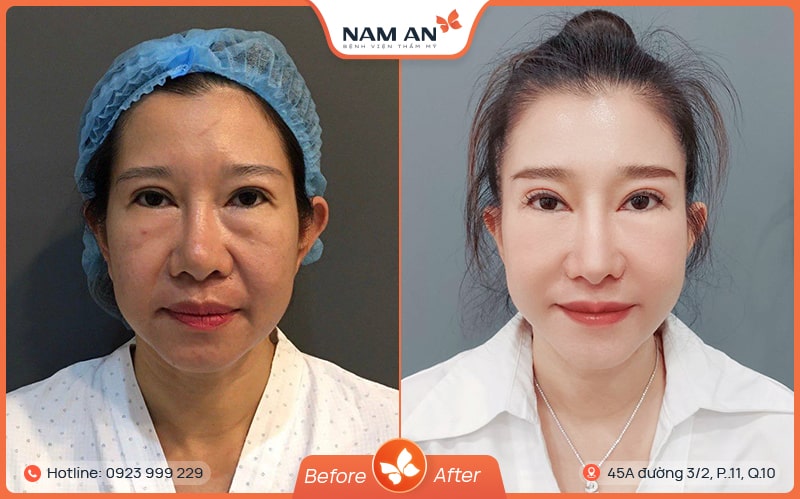sửa mũi hỏng đã nâng tphcm