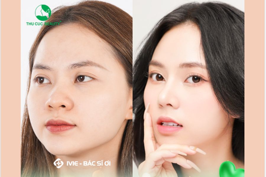 sửa mũi hỏng đã nâng hcm
