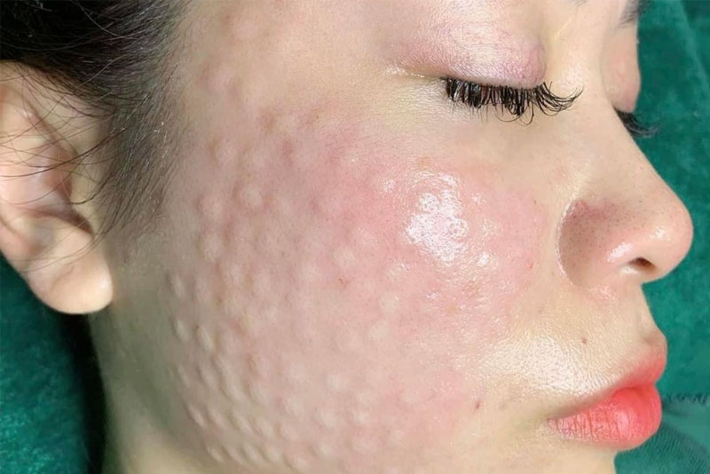 Địa chỉ tiêm meso đẹp Quận Tân Phú