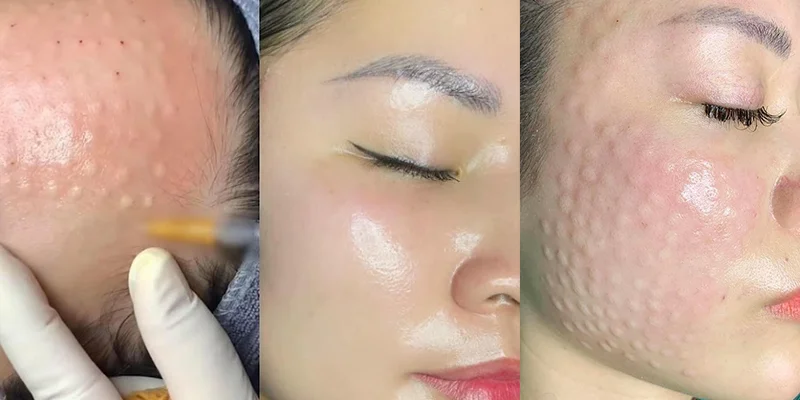 Địa chỉ tiêm meso đẹp Quận Tân Phú